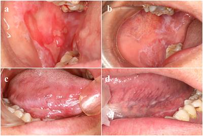 What can we learn from treatments of oral lichen planus?